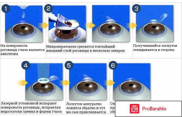 Лазерная коррекция зрения отзывы отрицательные отзывы