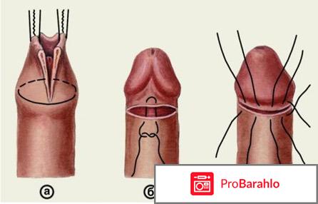Обрезание в москве отзывы 
