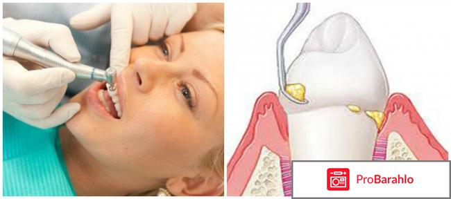 Зубной камень: удаление в клинике и домашних условиях 
