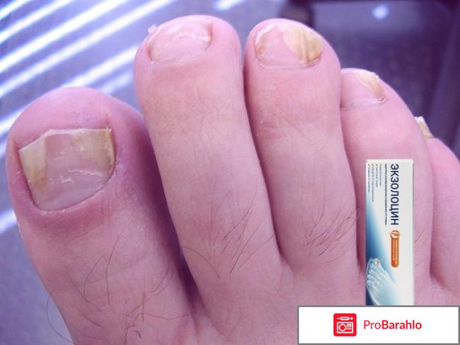 Гель против грибка Экзолоцин реальные отзывы