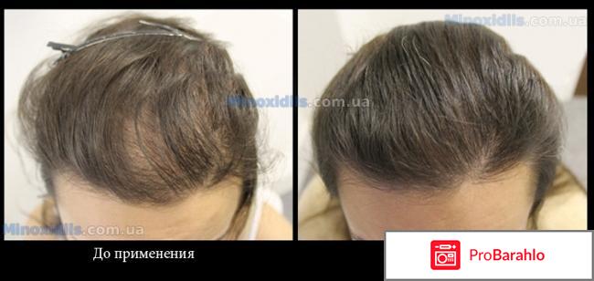 Minoxidil для волос отзывы 