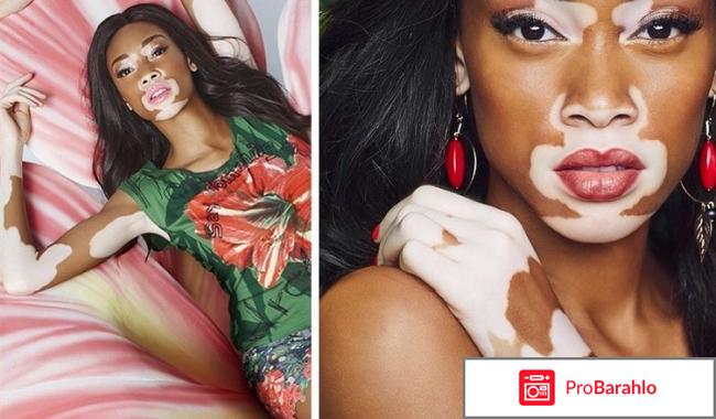 Я вылечила витилиго 