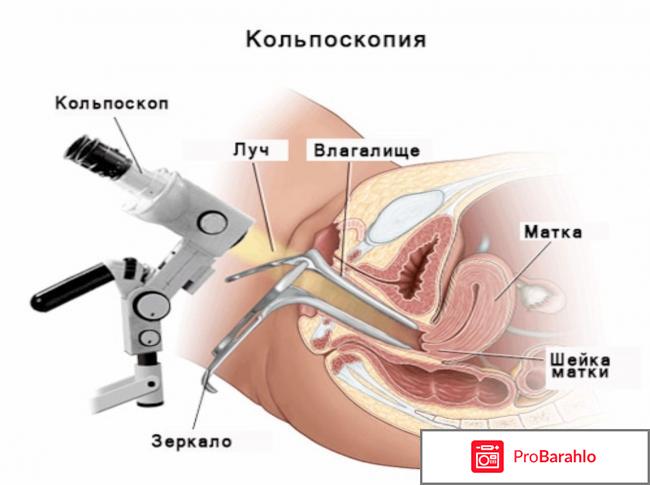 Эндометриоз диагностика обман