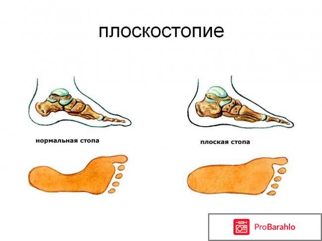 Плоскостопие операция 