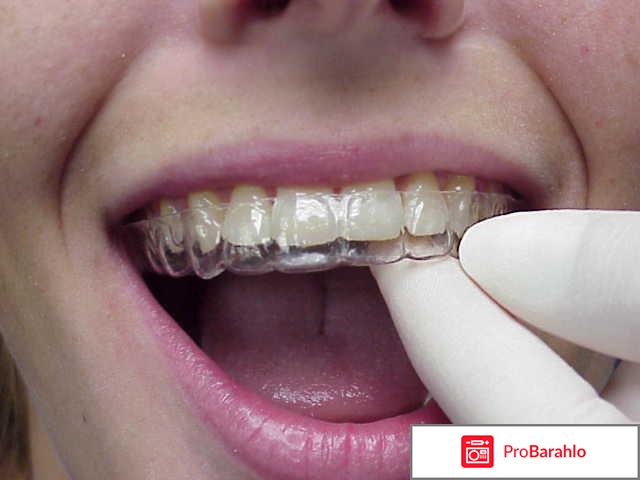 Исправление прикуса капой 