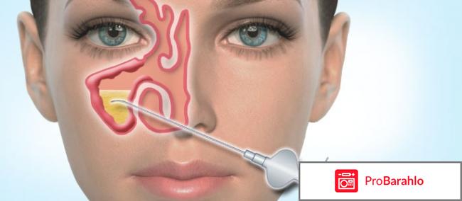 Прокол гайморита обман