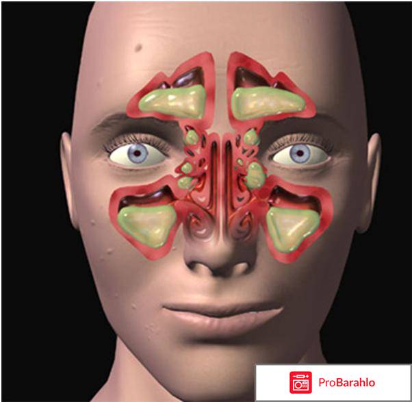 Из носа течет желтая жидкость что это отрицательные отзывы