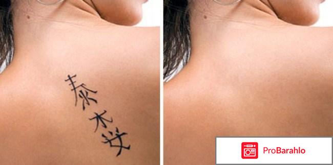 Удаление татуировок лазером 