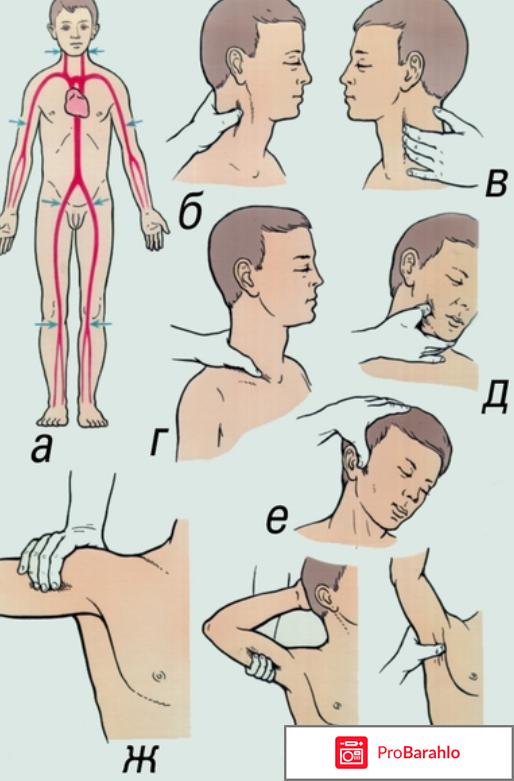 Первая помощь при внутреннем кровотечении отрицательные отзывы