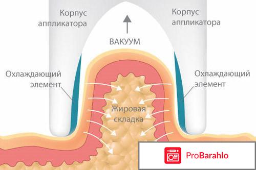 Криолиполиз отрицательные отзывы