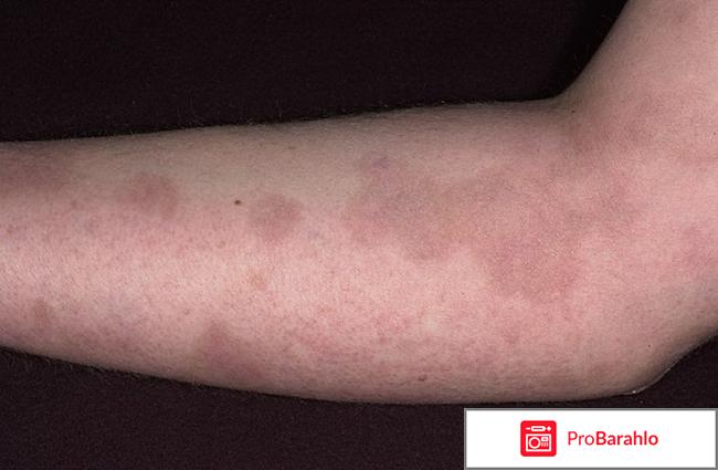 Хлоазма — Причины, симптомы и лечение 