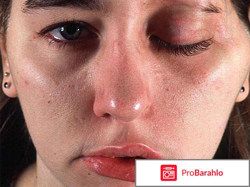 Диспорт фото до и после фото