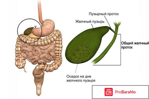 Взвесь в желчном пузыре что это и как лечить? реальные отзывы