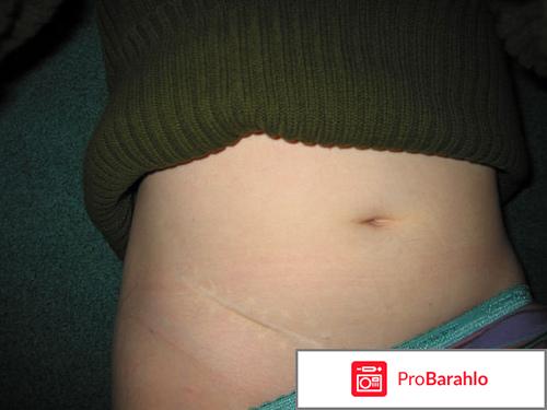 Где находится аппендицит 