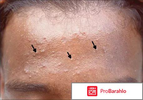 Крем против прыщей отрицательные отзывы