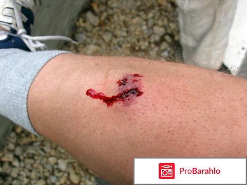 Рваная рана при укусе собаки 