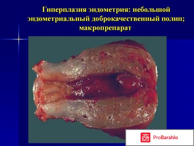 Гиперплазия эндометрия отрицательные отзывы
