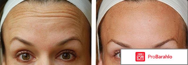 Диспорт фото до и после фото