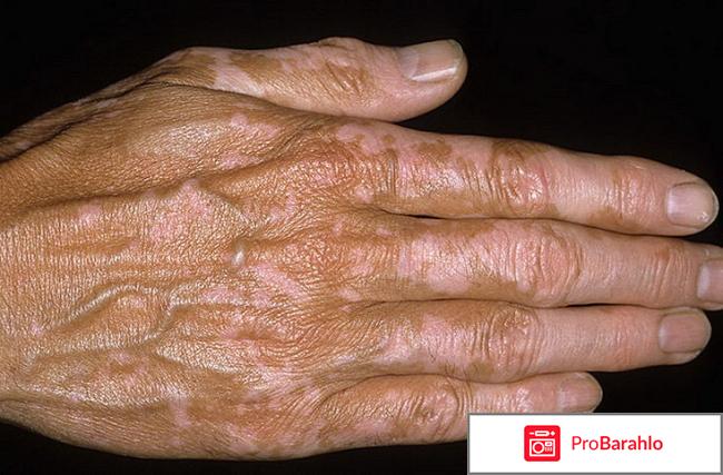 Кто-нибудь излечился от витилиго обман