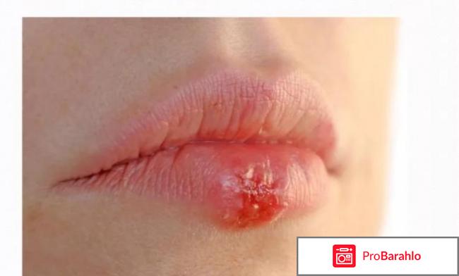 Валтрекс инструкция по применению цена отзывы отрицательные отзывы