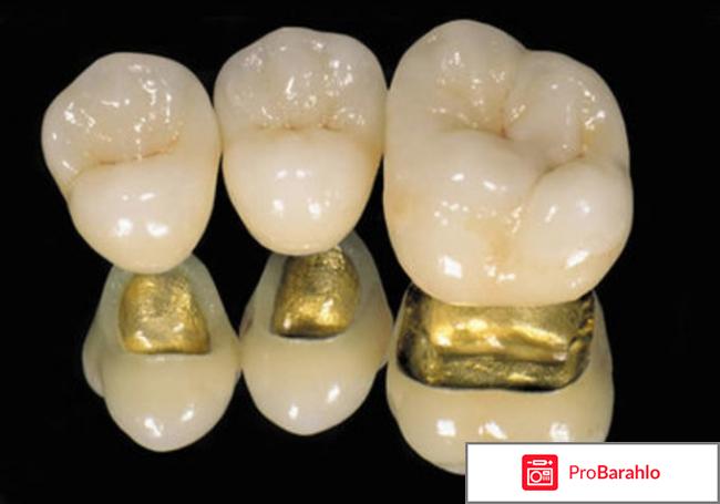 Зубные коронки какие лучше отзывы отрицательные отзывы