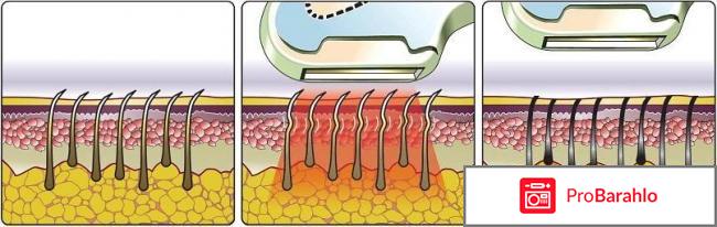 Фотоэпиляция дома 