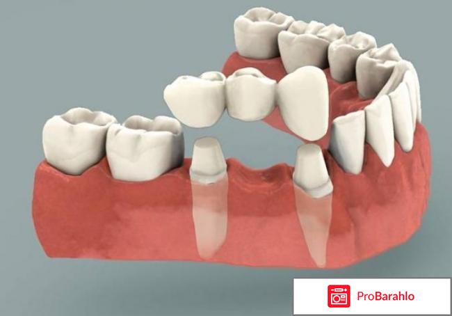 Что такое «мост» в стоматологии? Для чего в стоматологии используют «мост»? 