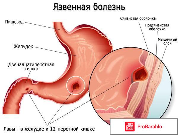 Язва луковицы двенадцатиперстной кишки обман