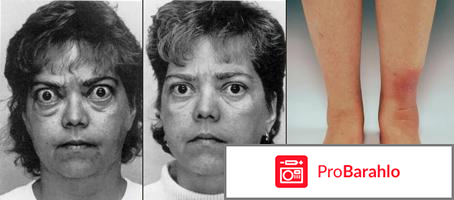 Противопоказания при гипертиреозе отрицательные отзывы