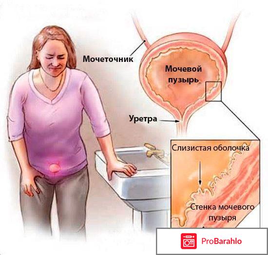 Цистит у женщин симптомы и лечение отзывы обман