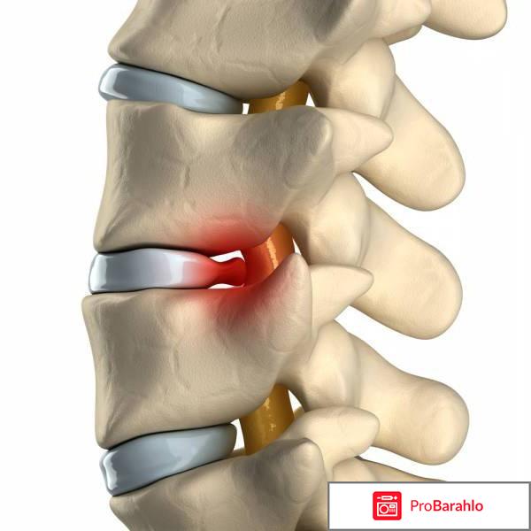 Хрустит шея что делать реальный отзыв обман