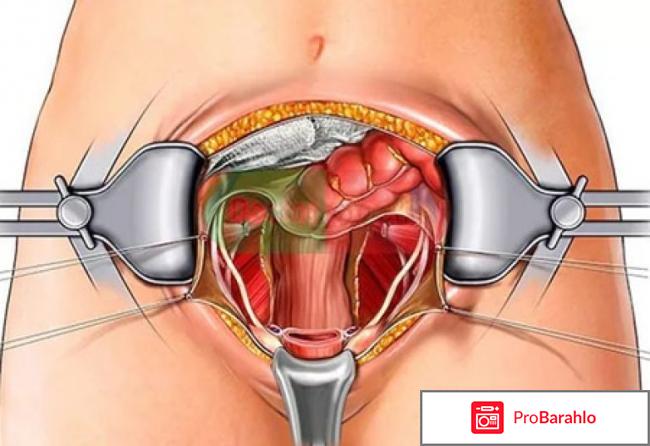 Удаление яичников у женщин последствия отзывы 