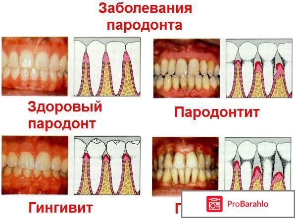 Как лечат пародонтоз 