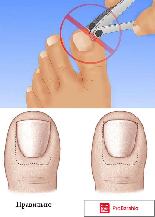 Вросшие ногти на ногах 