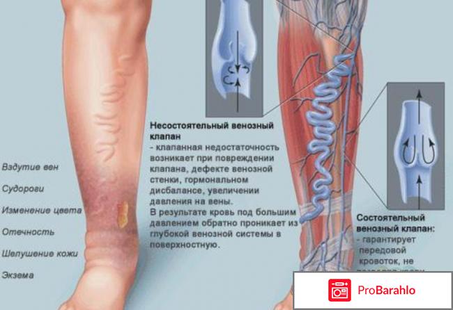 Крем от варикоза Варикрем обман