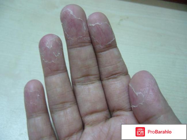 Слезает кожа на пальцах рук 