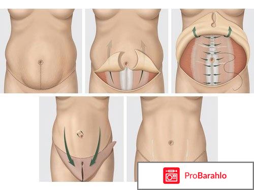 Абдоминопластика спб отзывы обман