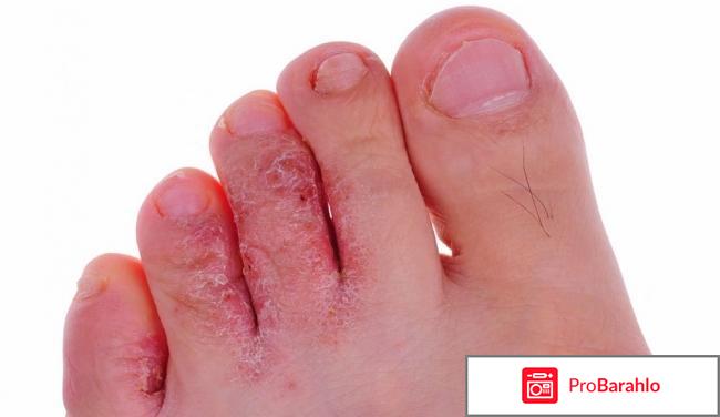 Тербинофиновая мазь инструкция цена отзывы отрицательные отзывы