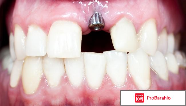 Имплантация зубов - шаг вперед в стоматологии 