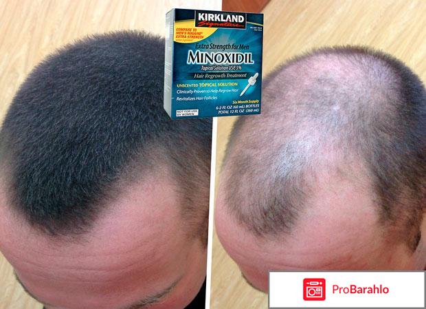 Миноксидил (Minoxidil) фото