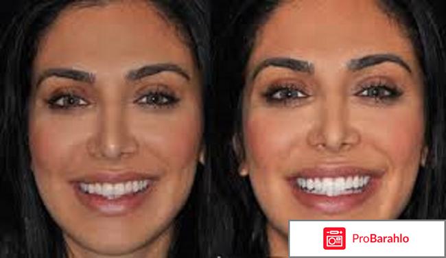 Tooth whitening обман