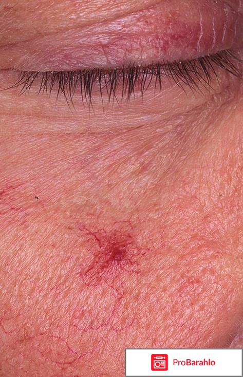 Пятна на теле 