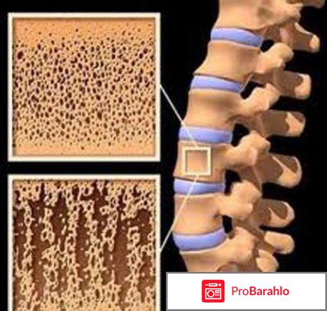 Профилактика остеопороза 