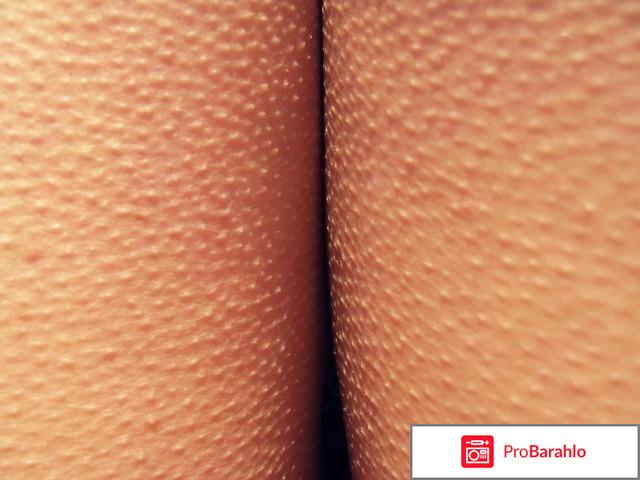 Как избавиться от гусиной кожи на попе отрицательные отзывы
