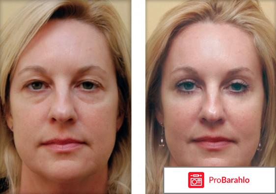 Гиалуроновая кислота в порошке купить в аптеке цена обман