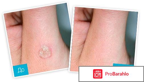 Papillock средство от папиллом и бородавок 