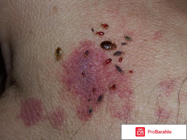 Укус клопа последствия 