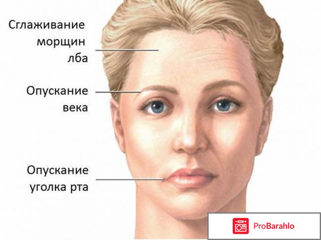 Неврит лицевого нерва отрицательные отзывы