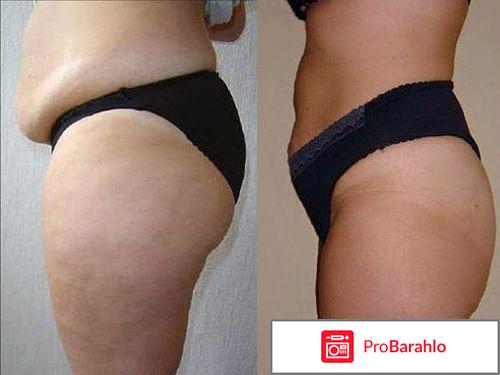 Липолитики для похудения отзывы фото отрицательные отзывы