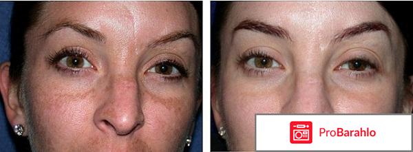 Срединный пилинг 